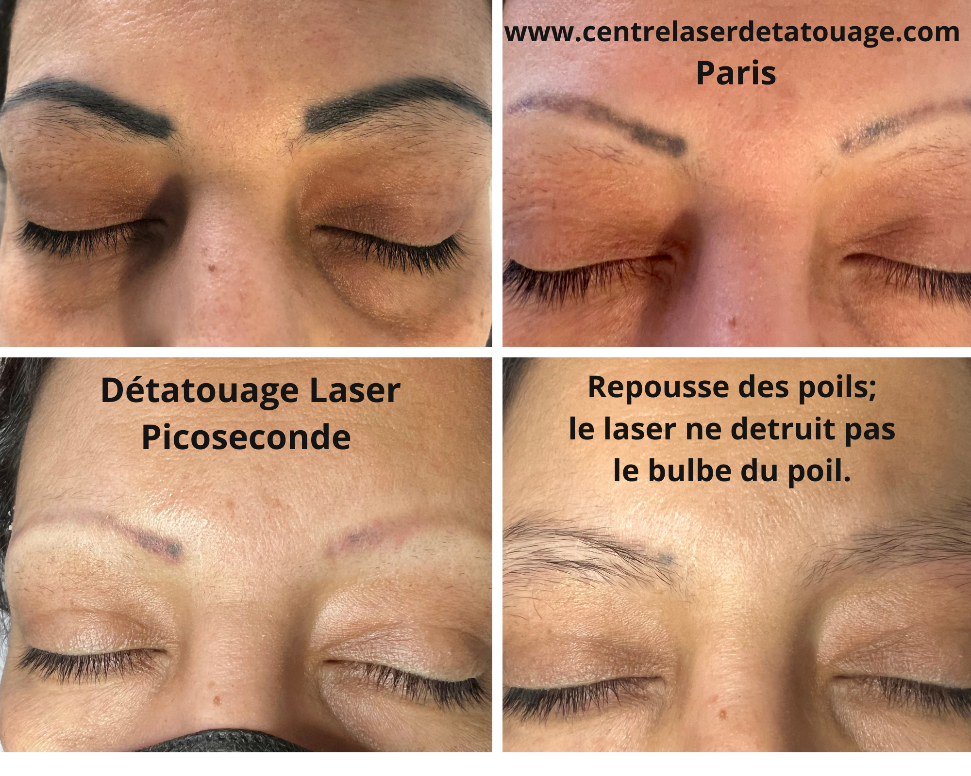 Laser Détatouage local pour retirer tatouage