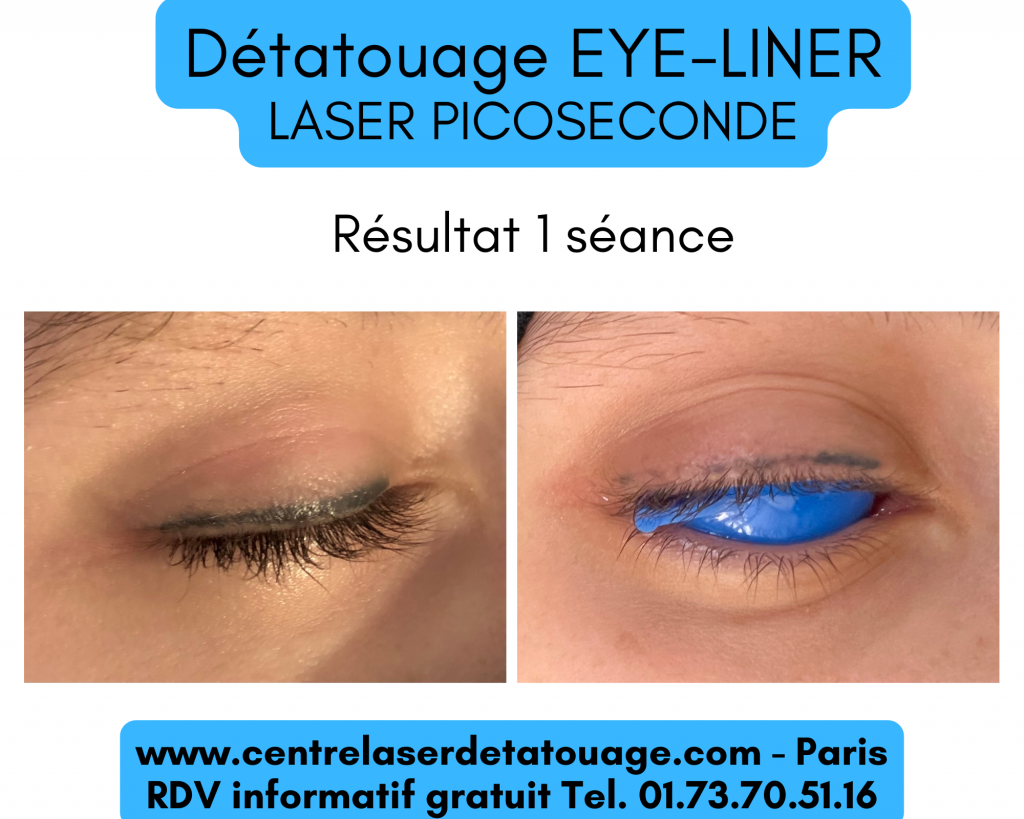 Laser Détatouage et Esthétique Paris, un nouveau centre laser doté de la dernière technologie en matière de retirer  eyeliner maquillage permanent.