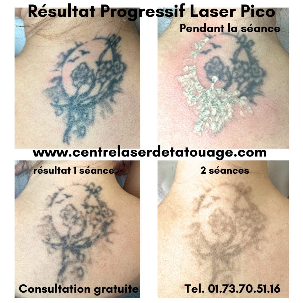Laser Détatouage local pour retirer tatouage