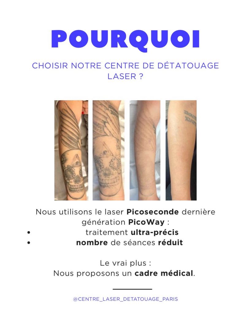 Centre Détatouage Laser Pico Paris 