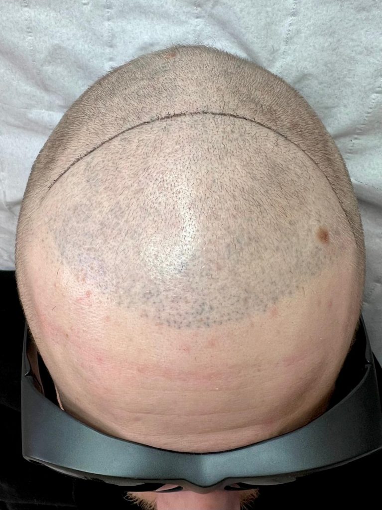 Enlever dermopigmentation capillaire à Paris