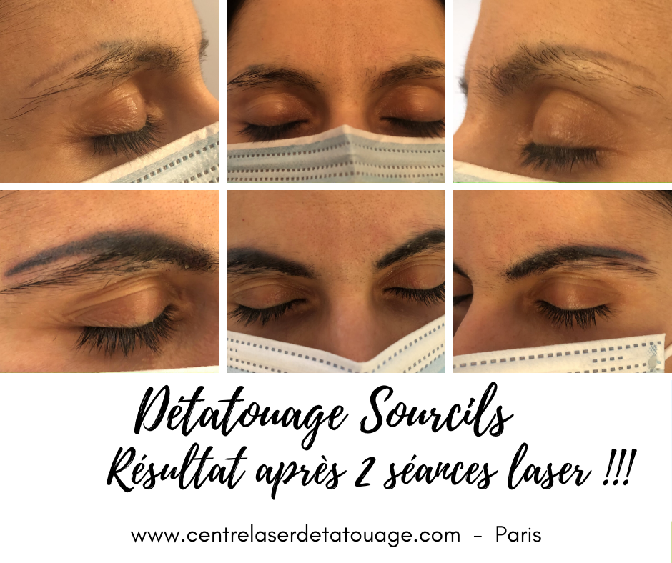 Détatouage sourcils au le laser