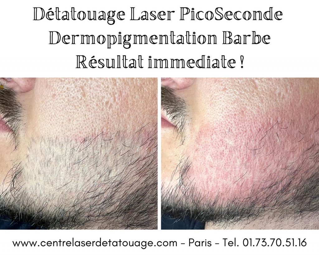 Détatouage sourcils avec le laser