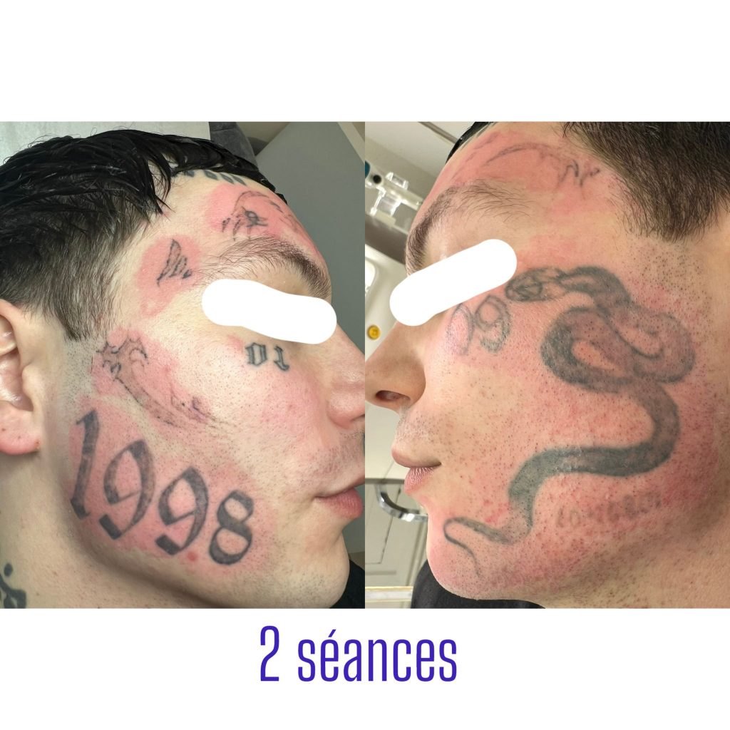 mieux détatouage resultat au laser avant