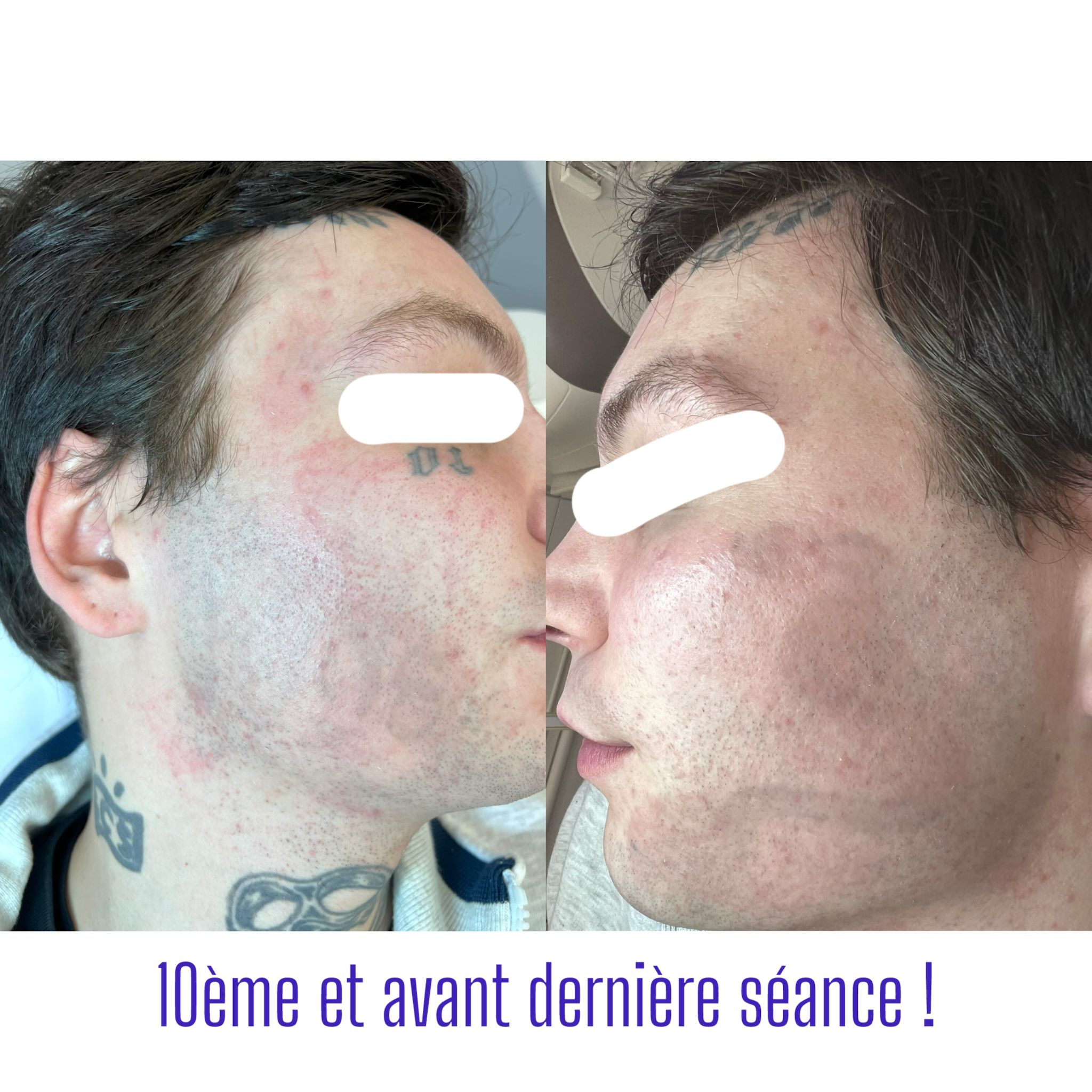Combien de séances pour enlever tatouage