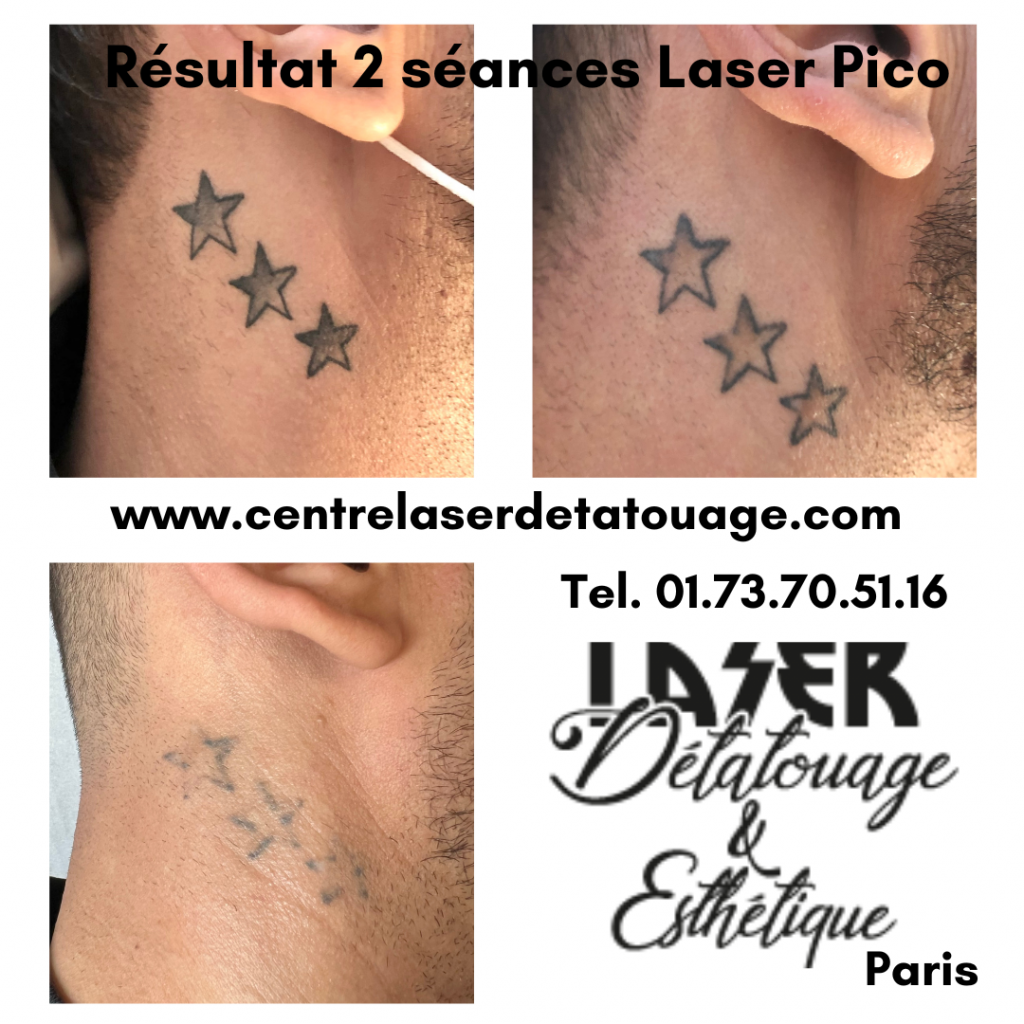 Laser Détatouage Résultat