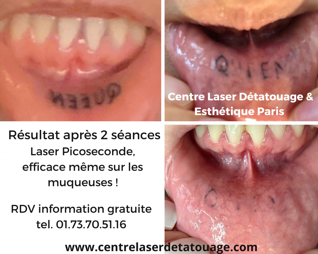 Laser Détatouage Résultat